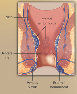 Dr. James Maher is the Cinco Ranch Texas Hemorrhoid doctor you need. He has more than three decades of experience.